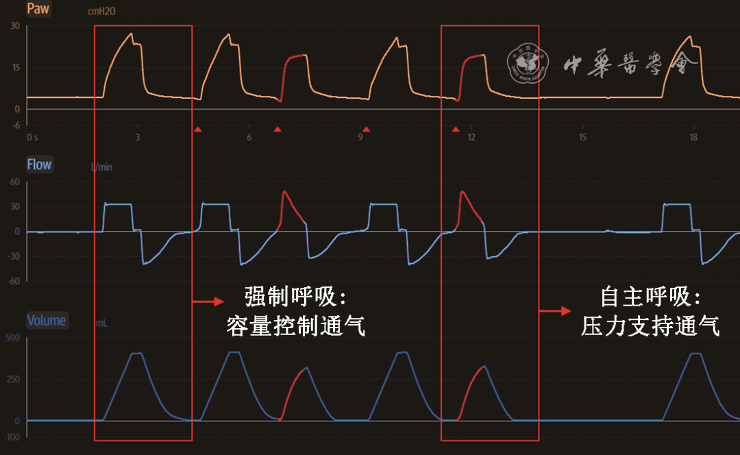 無(wú)創(chuàng)呼吸機(jī)