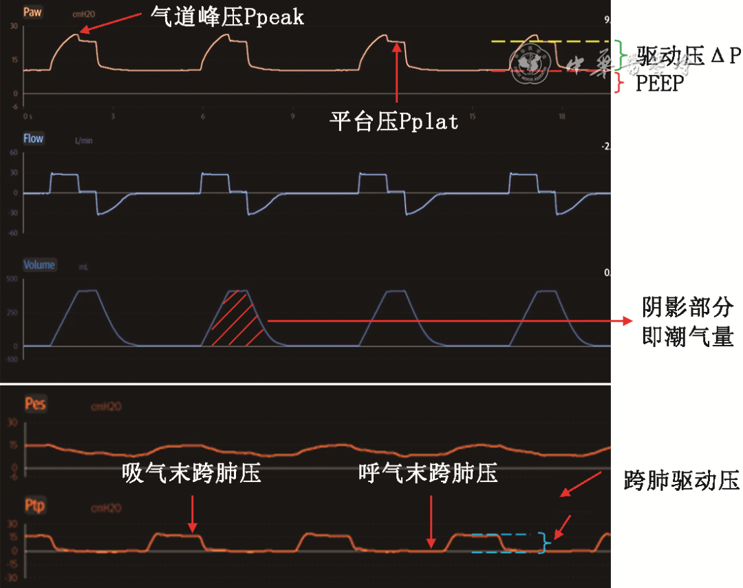 無(wú)創(chuàng)呼吸機(jī)