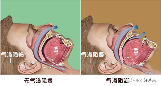 無(wú)創(chuàng)呼吸機(jī),高流量呼吸濕化治療儀,睡眠監(jiān)測(cè)