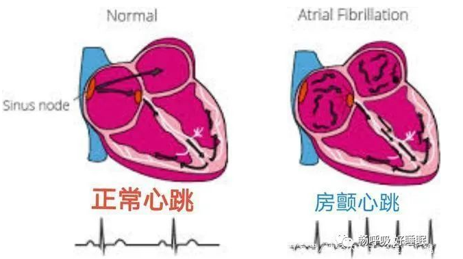 無(wú)創(chuàng)呼吸機(jī),高流量呼吸濕化治療儀,睡眠監(jiān)測(cè)