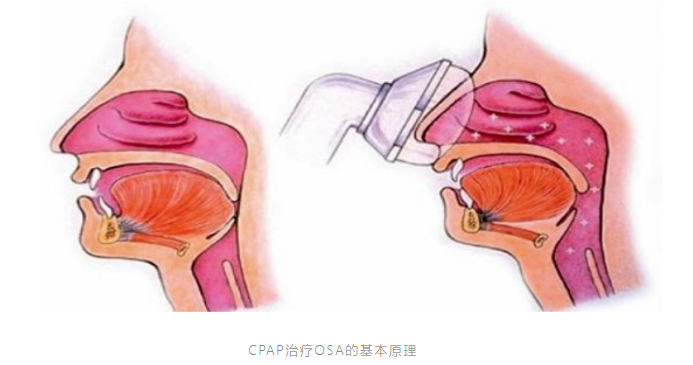 無創(chuàng)呼吸機,高流量呼吸濕化治療儀,睡眠監(jiān)測